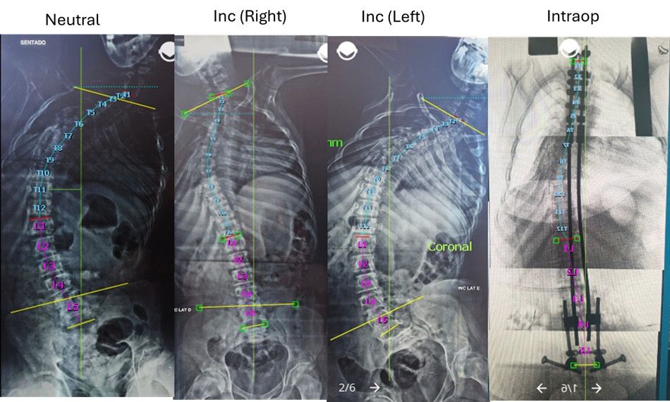 Você está visualizando atualmente Técnica Bipolar: correção cirúrgica da Escoliose Neuromuscular
