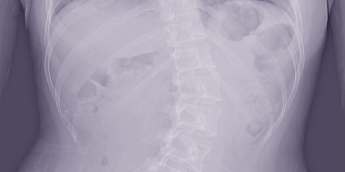 Escoliose Neuromuscular: Manejo Clínico-Cirúrgico